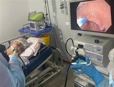 Disposable Biopsy Forceps Clinical Case (Los ntawm Chile Agent)